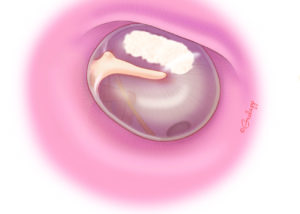 The finding of myringosclerosis should raise suspicion of tympanosclerotic ossicular fixation.