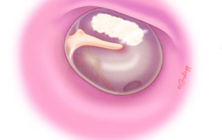 The finding of myringosclerosis should raise suspicion of tympanosclerotic ossicular fixation.