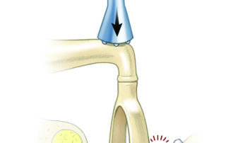 Mobilization is also possible in tympanosclerotic fixation, but the fixation tends to recur. Stapedectomy is usually avoided in tympanosclerotic fixation unless the ear has a long infection-free period, the middle ear mucosa is mostly healthy, and the tympanic membrane is not prone to retraction.