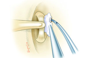 Attempt should be made to chip away the fixing bridge of tympanosclerosis. When thoroughly removed, the stapes has a good chance of retaining mobility.