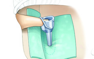 A Lippy modified prosthesis with an elongated bucket is designed to accommodate a deficient incus.