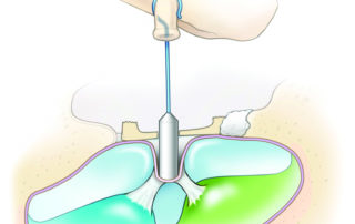 Due to adhesion with the endolymphatic membranes, removing an overly inserted prosthesis carries a risk of inner ear damage.