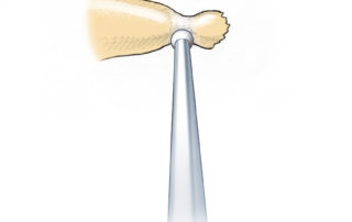 Because a fractured incus will not retain a wire without modification, a groove is created to anchor the crimp.