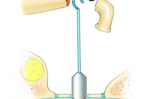 Fracture of the long process of the incus. This may occur due to a movement of a loose prosthesis, an overly hermetic crimp resulting in devascularization of the lenticular process, or fragile incus as in osteogenesis imperfecta.