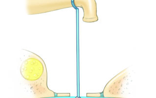An overly long prosthesis may cause vestibular symptoms, especially vertigo triggered by loud sounds (Tullio’s phenomenon).