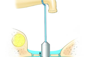 Perilymphatic fistula may be associated with sensory loss and/or vestibular symptoms.