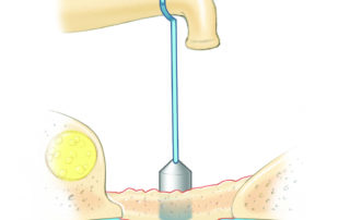 Bony reclosure of the oval window. Because repeat drill out of recurrent obliterative otosclerosis carries a heighted risk of sensory loss, consideration should be given to amplification.
