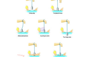 The seven most common findings encountered during revision stapes surgery.