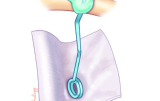 A drop of cement may be placed to reinforce the stability of the malleus crimp.