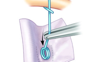 The malleus to footplate prosthesis seated into position.