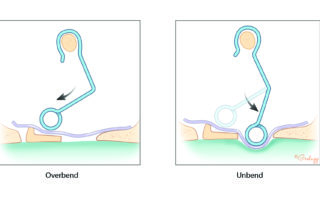 The bend is progressively straightened until the desired tension is achieved.