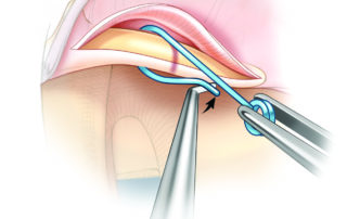 The IRP is tied around the malleus with a hook while the prosthesis is stabilized with an alligator.