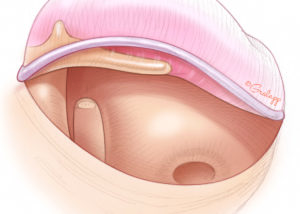 An absent or insufficient incus represents a technical challenge in stapes surgery.