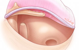 An absent or insufficient incus represents a technical challenge in stapes surgery.