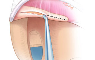 Incision is made in the posterior aspect of the umbo with either a myringotomy knife or laser.