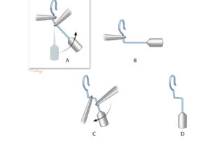 To route the wire around a dehiscent facial nerve, the double-bend technique may be used. This requires adding 1 mm to the length of the wire. Using two smooth alligators, two bends are created as depicted.