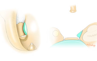An oval window may be narrowed by a promontory scroll which limits access for footplate fenestration.