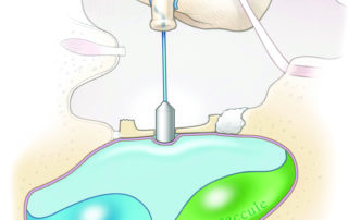 The normal position of a stapes piston in the vestibule. The piston should be only approximately 0.5 mm into the vestibule. Over time, the endosteal membrane reforms underneath the piston. Once this membrane has reformed, the piston does not directly contact perilymph. It can be thought of as residing in a diverticulum of the middle ear.