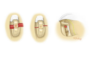 If the surgeon encounters a large persistent stapedial artery, then it is best to stop the procedure and recommend amplification. A vestigial stapedial artery remnant is quite common and should not deter completion of the procedure.
