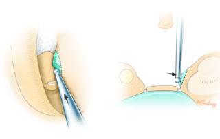Using a diamond burr, the promontory scroll can be removed slightly inferior to the level of the annular ligament with no fear of entering the cochlea.