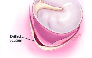 Marginal dehiscence of the flap due to either too short of a flap design or a long scutum necessitating more extensive bone removal than the flap can cover.