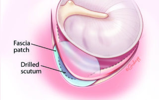 Marginal dehiscence should be repaired with a perichondrial or fascial graft.