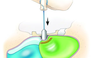 Stapes surgery is contraindicated in hydrops due to risk of the piston traumatizing the otolithic organs. Among other complications, this can lead to Tullio’s phenomenon (vertigo with loud noise).