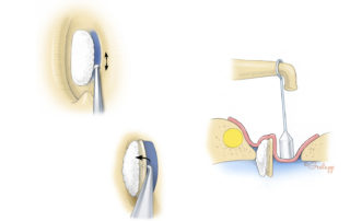 One technique for dealing with a biscuit footplate is the so-called log roll maneuver. A thin trough is drilled on the promontory side (to overcome restriction from the inner flange) and the footplate is rolled up on its side.