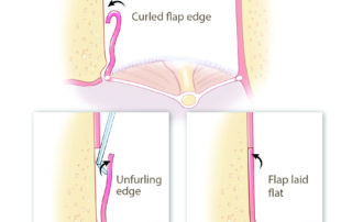After repositioning the flap, a joint knife may be used to unfurl the curled edge to ensure the flap lies flat against the bony canal.