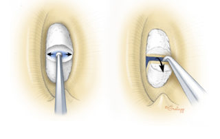 Dealing with a biscuit footplate is one of the great challenges in stapes surgery. The problem is that when drilling starts, it tends to become mobile. Drilling on a mobile footplate is forbidden due to risk of sensory loss. Once mobilized, manipulation tends to depress the biscuit footplate into the vestibule. Under favorable circumstances, the thick footplate can be bisected and the posterior half delivered.