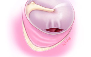 Tympanic membrane tear sustained during flap elevation.
