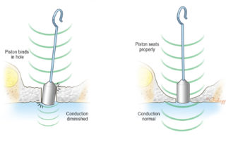 In reducing the thickness of the footplate in obliterative otosclerosis, it is important to create an adequate thin area. If the opening is too narrow (left), then the prosthesis will rub if it is even slightly off line with the opening.