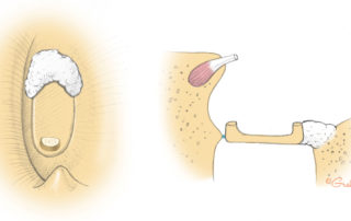 Anterior fixation of the footplate is most commonly encountered.