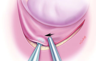 A joint knife may be used to unfurl the edge to ensure the flap lies flat against the bony canal.