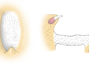 An obliterative footplate is thick and tightly fixed. The footplate appears chalky white and blood tends to accumulate in its center.