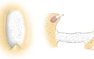 An obliterative footplate is thick and tightly fixed. The footplate appears chalky white and blood tends to accumulate in its center.