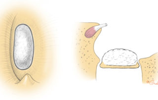 A biscuit footplate is thick and white, but is lightly fixed. Blood pools peripherally around the annular ligament. A flange may be present on the vestibule side which makes its extraction difficult.