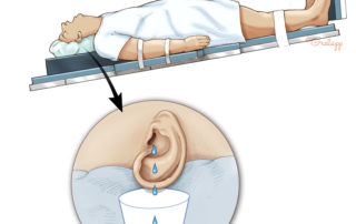 In true stapes gusher, brisk CSF flow prohibits orderly microdissection. Rather than packing the oval window in panicked fashion with poor visualization, it is better to drop the head into Trendelenburg and allow the CSF to escape.