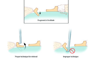 When a footplate fragment begins to fall into the oval window, it is a central axiom of stapes surgery not to reach into the vestibule. Often the fragment can be retrieved by engaging the crural base remnant with a hook. When a footplate fragment begins to fall into the oval window, it is a central axiom of stapes surgery not to reach into the vestibule. Often the fragment can be retrieved by engaging the crural base remnant with a hook.
