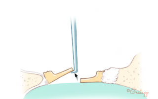 A hook is used to extract the posterior half of the footplate. A hook is used to extract the posterior half of the footplate.