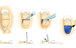 When the footplate crack is thin and nondisplaced, an obtuse (45-degree) hook is needed as a crack opener. This is the most useful tool to have on a stapes set. Once the posterior half has been elevated, a broad 90-degree hook (e.g., Hough hoe) can be used. When access is adequate, it is better to use a broad surfaced hook rather than a pointed one, as the latter can chip fragments of bone rather than lift the segment whole. When the footplate crack is thin and nondisplaced, an obtuse (45-degree) hook is needed as a crack opener. This is the most useful tool to have on a stapes set. Once the posterior half has been elevated, a broad 90-degree hook (e.g., Hough hoe) can be used. When access is adequate, it is better to use a broad surfaced hook rather than a pointed one, as the latter can chip fragments of bone rather than lift the segment whole.