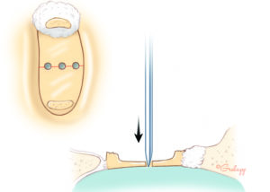 In traditional large fenestra technique, one-half or more of the footplate is removed. A sharp straight needle is used to create a series of footplate perforations across the meridian of the footplate. Some surgeons keep a sharpening stone on their set to remove any barbs from the needle before this maneuver. A dull needle might crack the footplate.