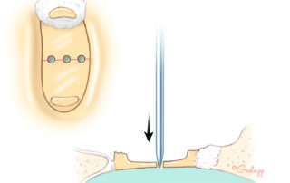 In traditional large fenestra technique, one-half or more of the footplate is removed. A sharp straight needle is used to create a series of footplate perforations across the meridian of the footplate. Some surgeons keep a sharpening stone on their set to remove any barbs from the needle before this maneuver. A dull needle might crack the footplate. In traditional large fenestra technique, one-half or more of the footplate is removed. A sharp straight needle is used to create a series of footplate perforations across the meridian of the footplate. Some surgeons keep a sharpening stone on their set to remove any barbs from the needle before this maneuver. A dull needle might crack the footplate.