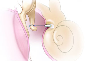 Small fenestra technique.