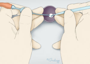 Placement of the surgeon’s hands during transcanal stapes microsurgery. The third and fourth fingers of each hand stabilize the speculum. Note that the microinstrument (right hand) and suction (left hand) are held in a manner to both optimize stability and to enable binocular viewing. Some surgeons use a speculum holder to enhance stability.