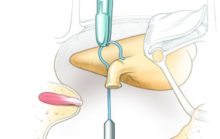 Placement of a stapedotomy piston.