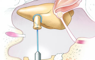 Completed placement of the stapes piston through the stapes fenestra into the vestibule.