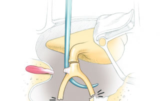 Removal of the stapes superstructure using a curved needle.