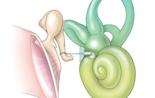 Schematic illustrating small fenestra stapedotomy with a Teflon-wire prosthesis.