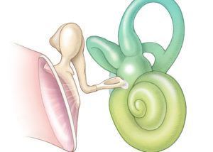 Schematic coronal view of the middle and inner ear showing a fixed stapes due to an otosclerotic plaque at the anterior margin of the oval window.